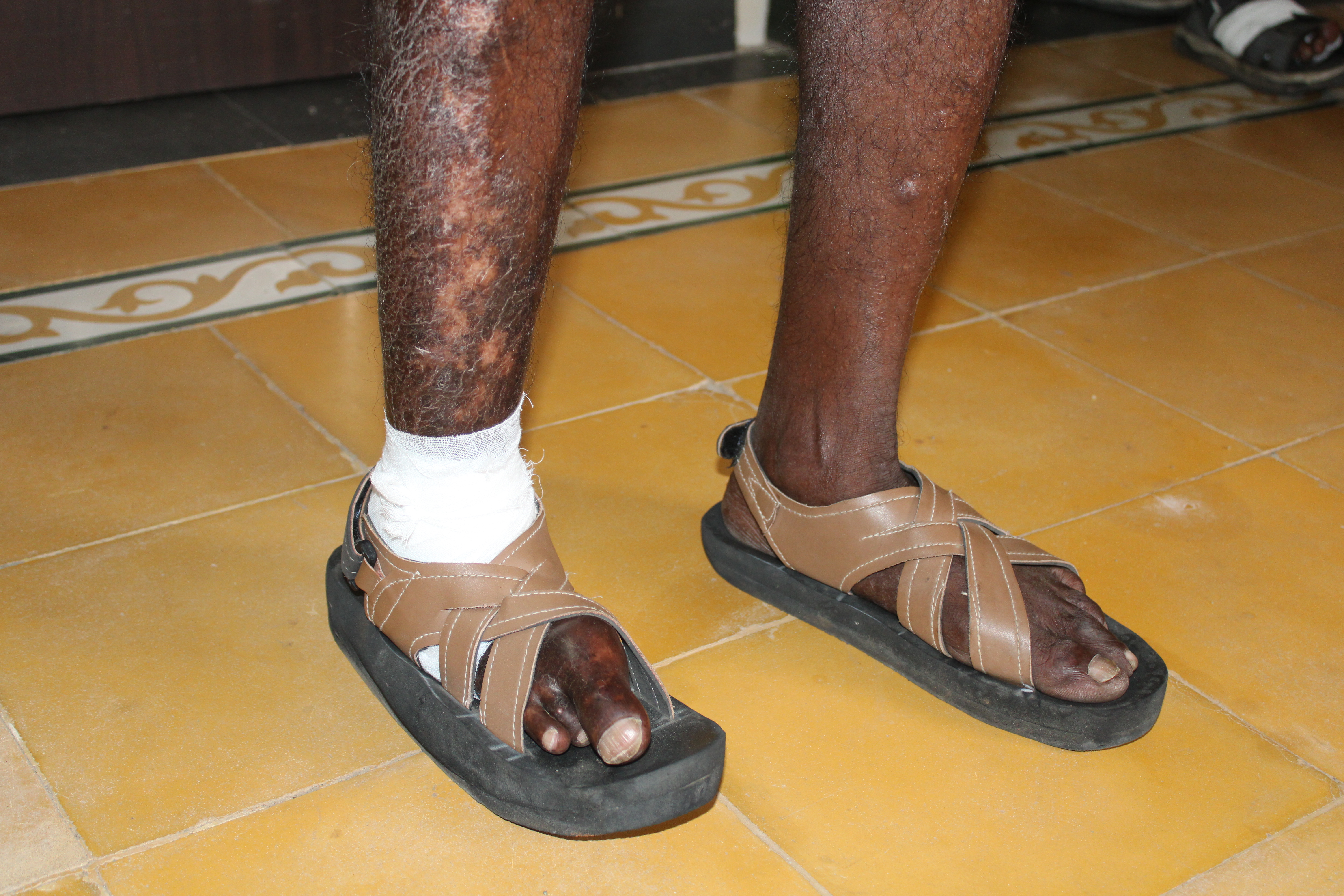 Leprosy Care image 22